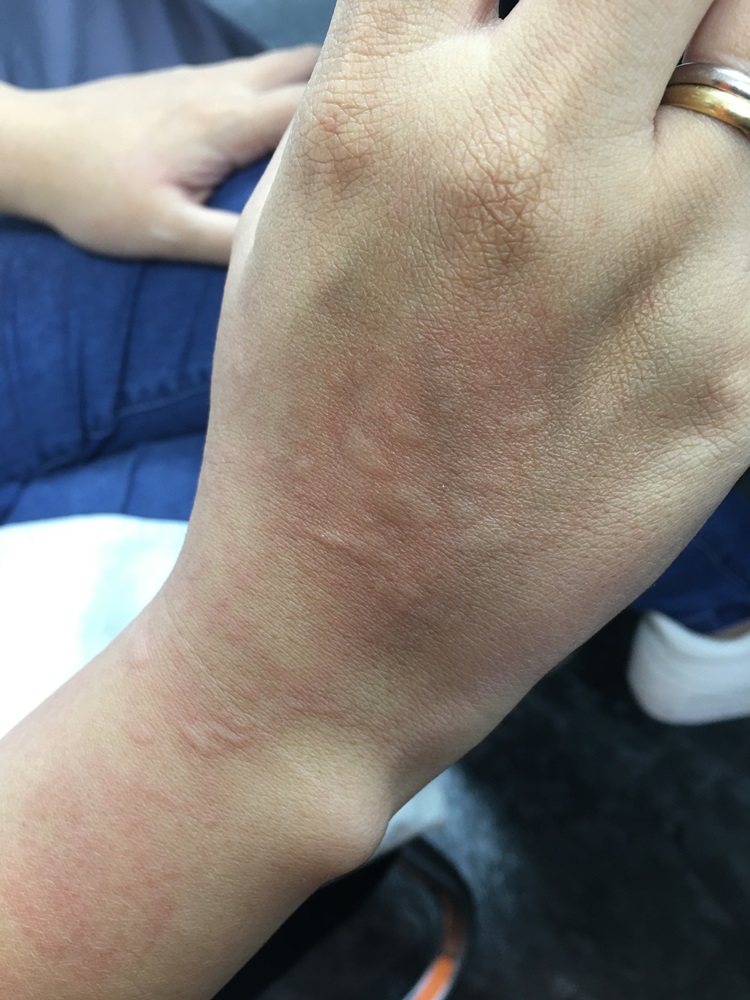 蕁麻疹手部症狀